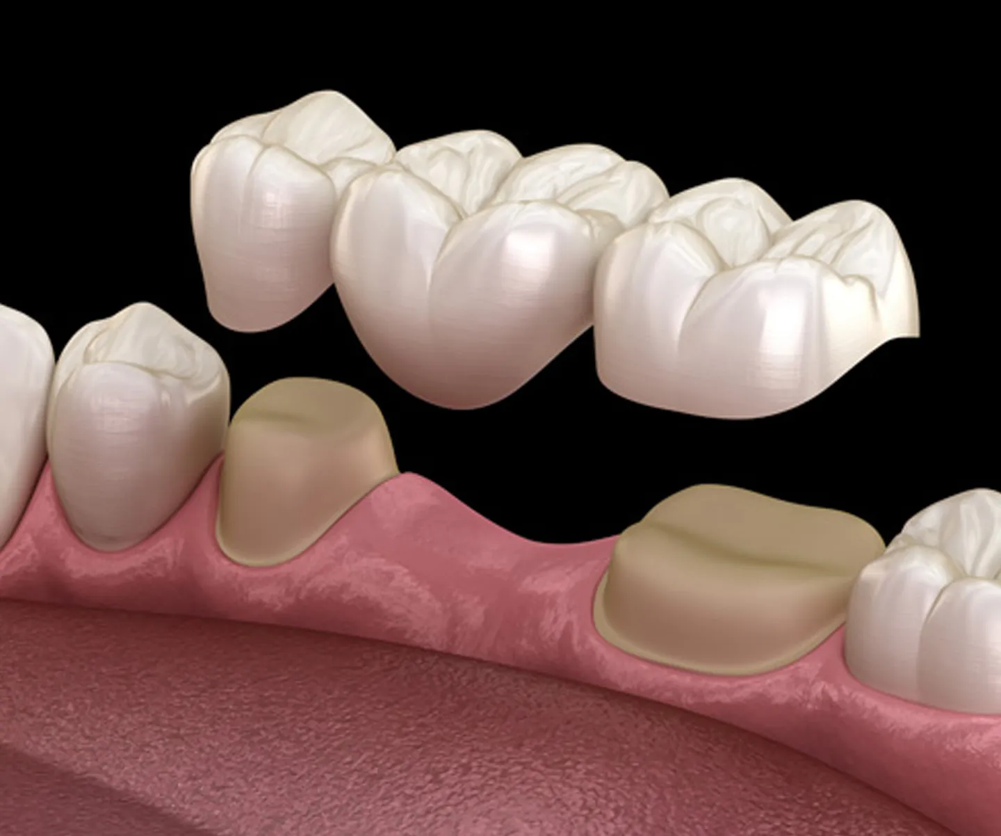 Dental crowns and bridges restoration at Blossom Dental Clinic Ahmedabad
