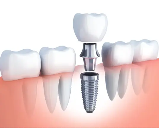 Dental implant procedure at Blossom Dental Clinic Ahmedabad