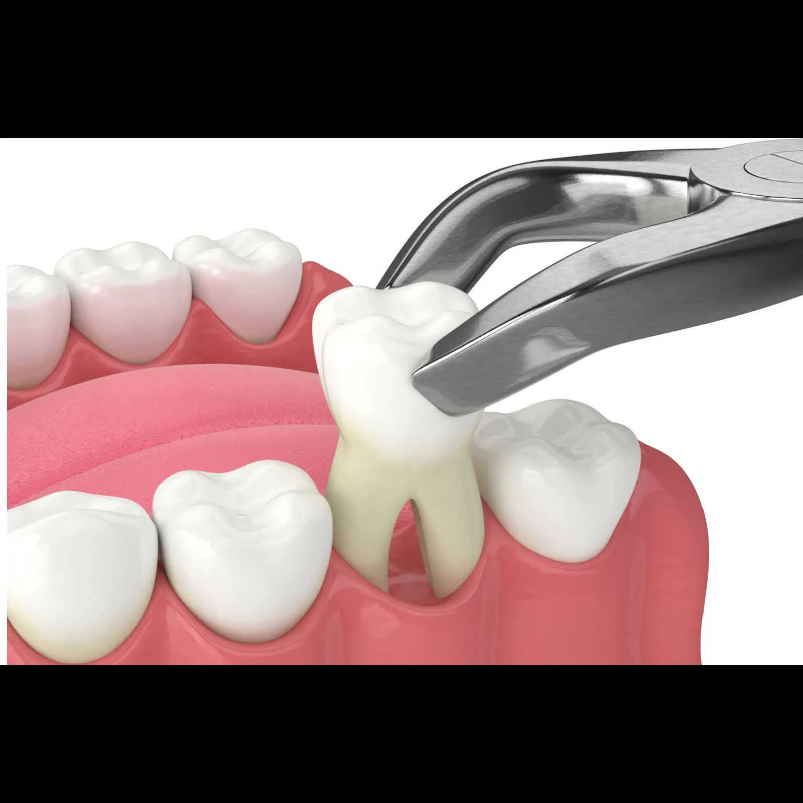 Oral surgery and tooth extraction at Blossom Dental Clinic Ahmedabad