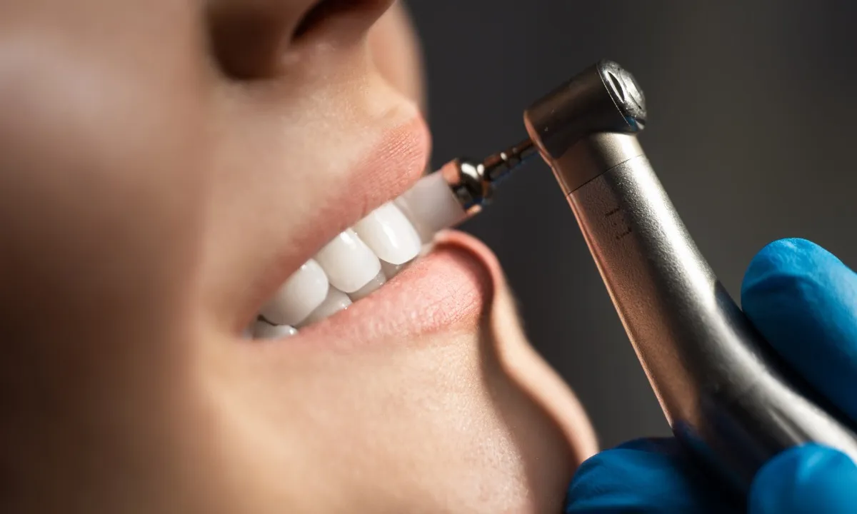 Professional dental scaling and polishing at Blossom Dental Clinic Ahmedabad