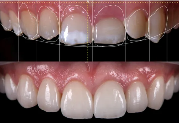 Smile design and cosmetic dentistry at Blossom Dental Clinic Bodakdev Ahmedabad