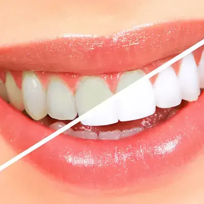 Professional teeth whitening treatment Ahmedabad