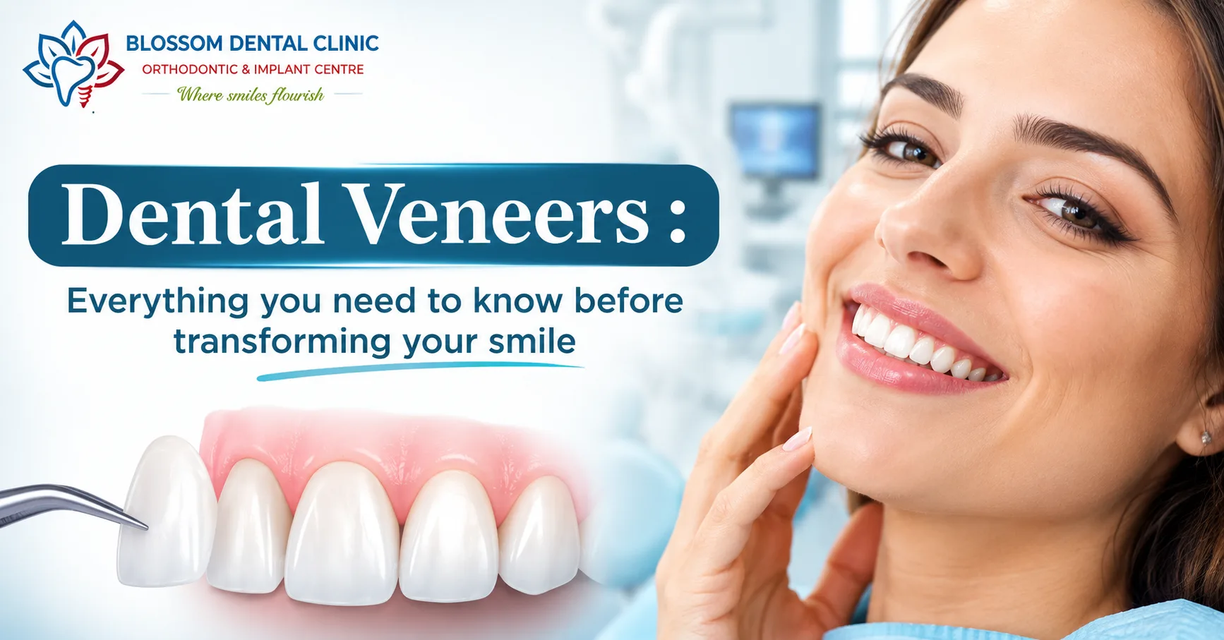 Dental Veneers: Everything You Need to Know Before Transforming Your Smile