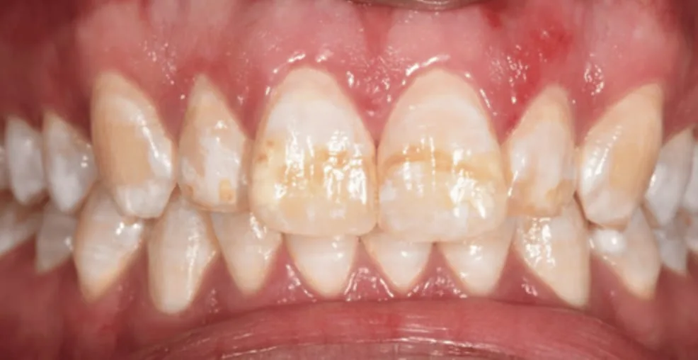 Dental flourosis