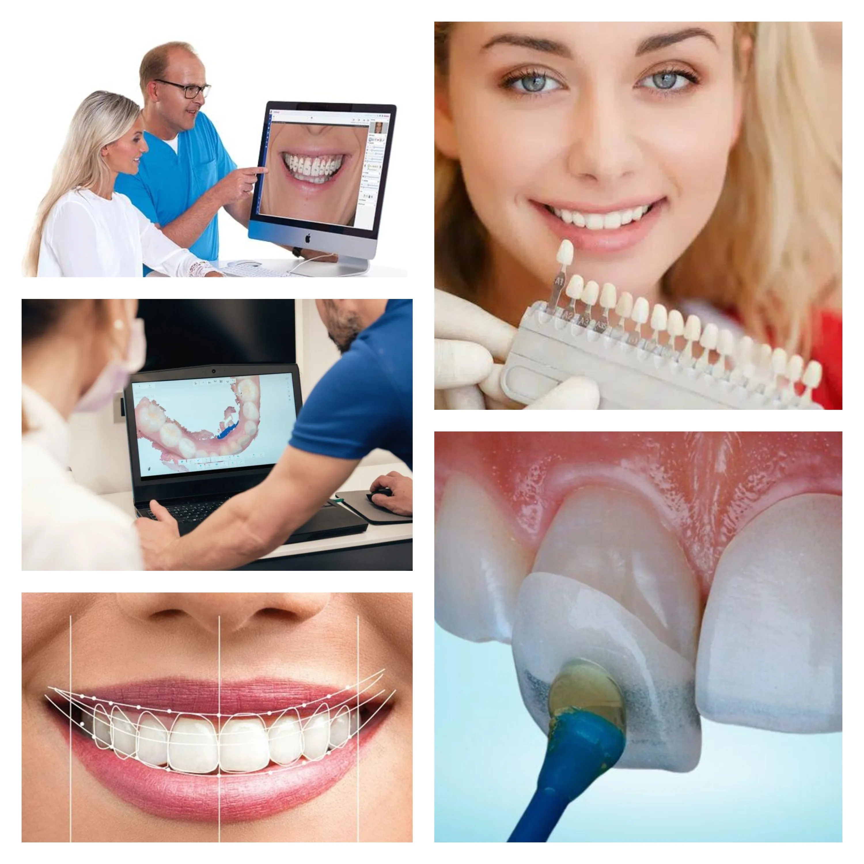 Digital smile design ; The process
