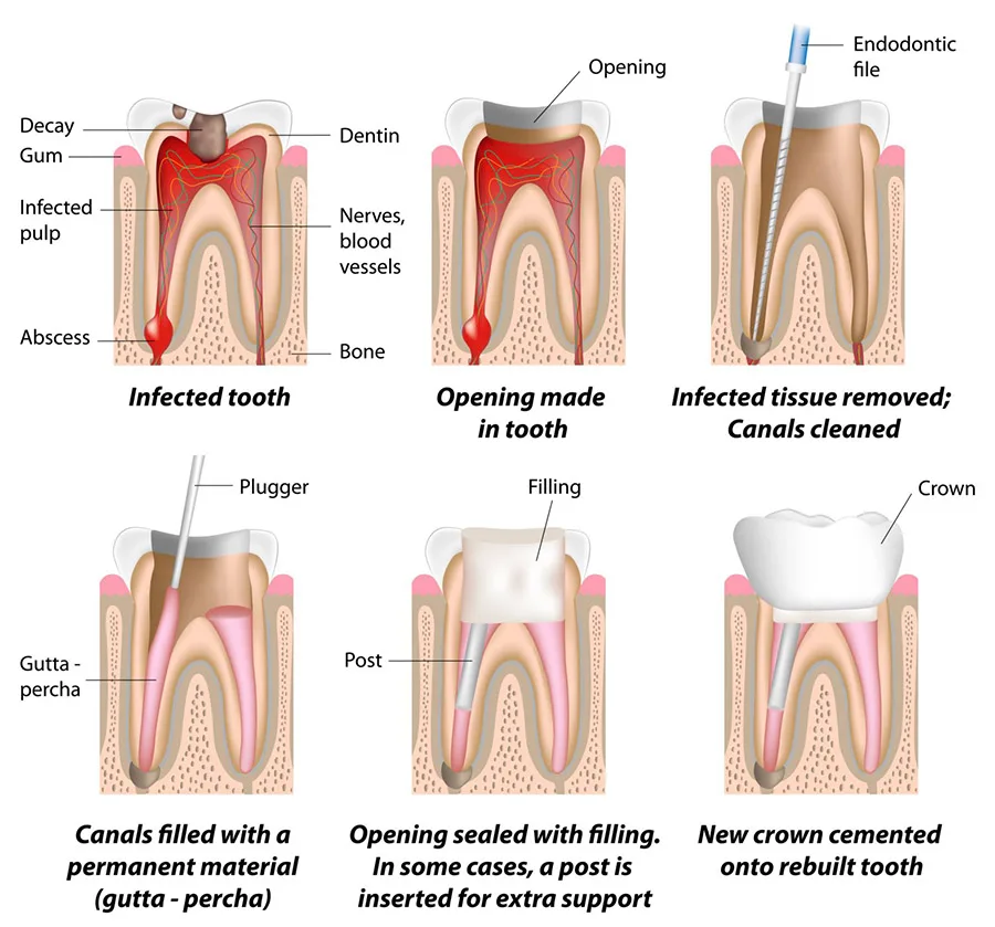Steps in Root Canal treatment