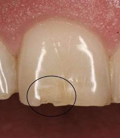 Chipped off teeth