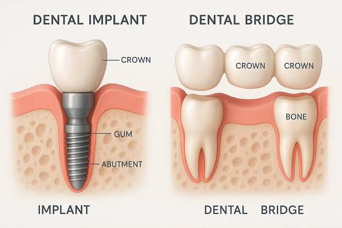 Dental Implant vs. Dental Bridge