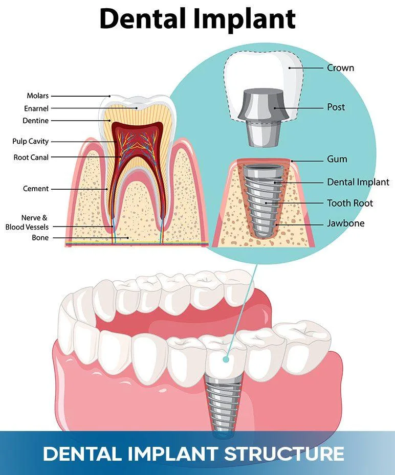 Dental Implant