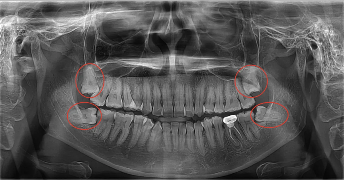 Impacted wisdom teeth