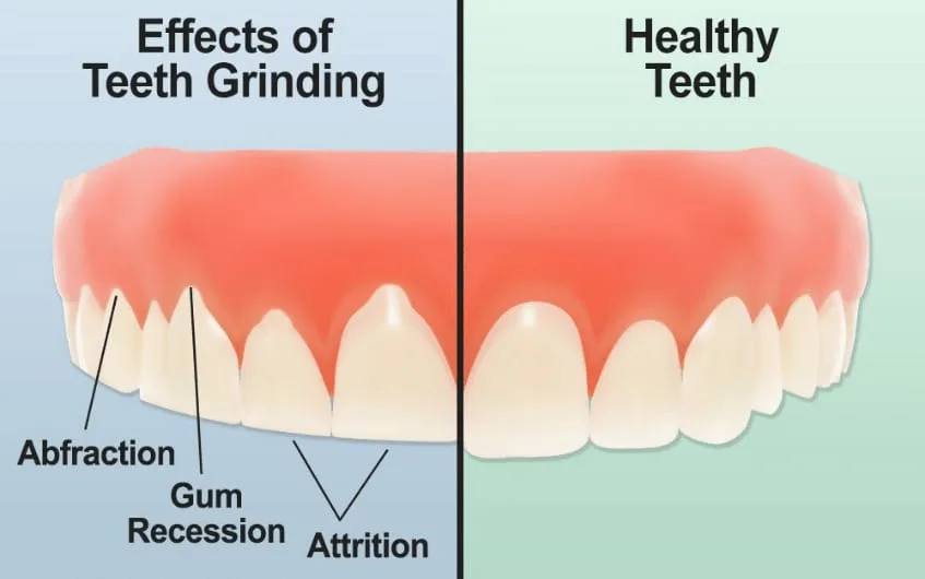 Teeth grinding