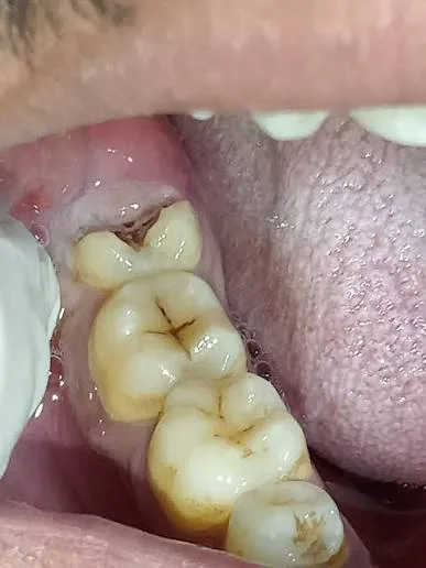 Decayed and impacted wisdom teeth