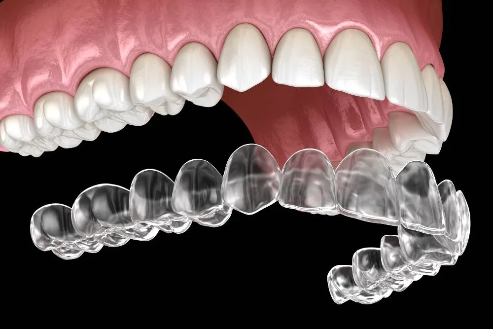 Clear aligners