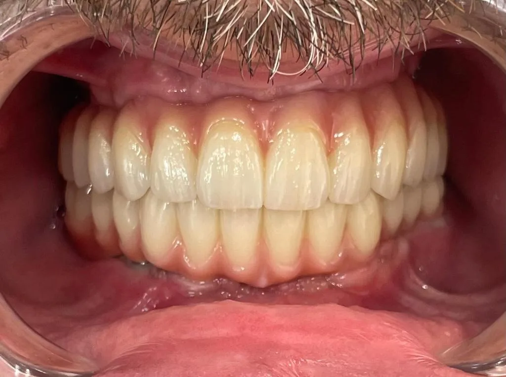 Full mouth implant rehabilitation