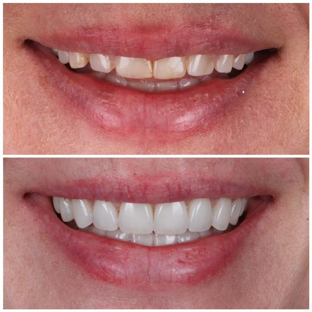 Veneers - Before & After