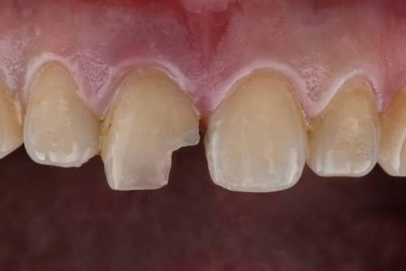 Fractured teeth