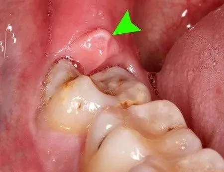 Pericoronitis