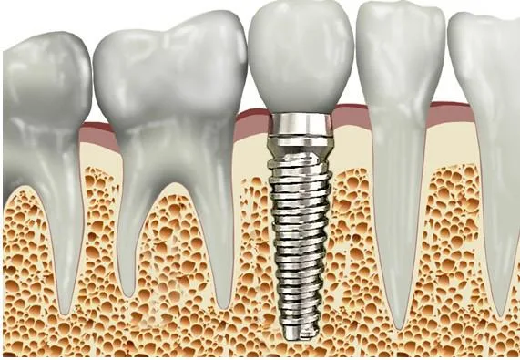 An implant preserves the jaw bone