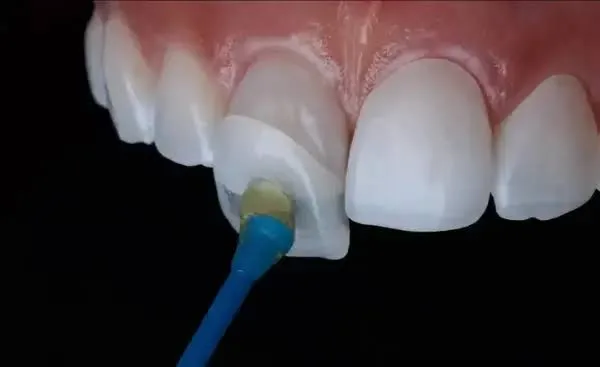Dental veneers
