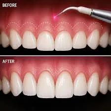Gum contouring