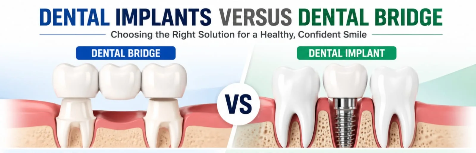 Dental Implants vs Dental Bridges: Which Is the Better Option for Replacing Missing Teeth?