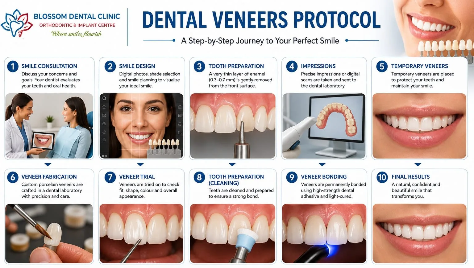 Dental Veneers protocol