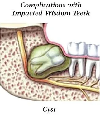 Illustration of cyst around wisdom tooth
