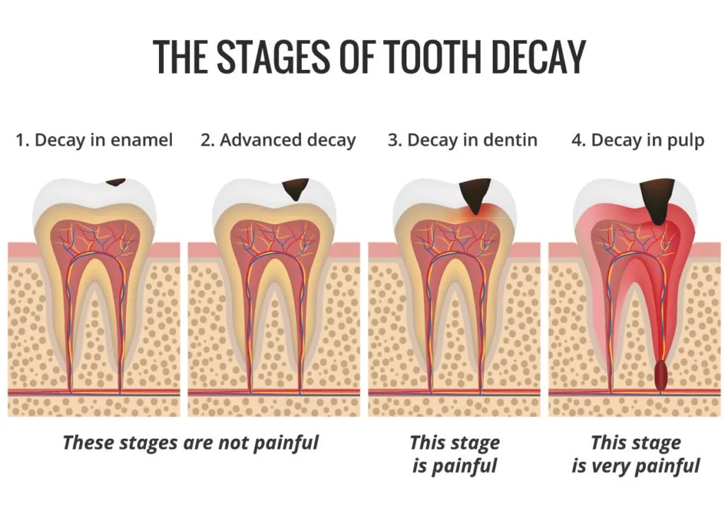 Stages of tooth decay