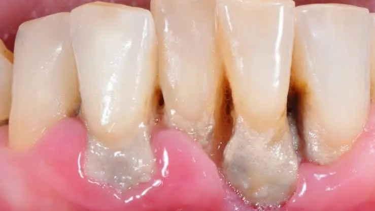 Gum disease