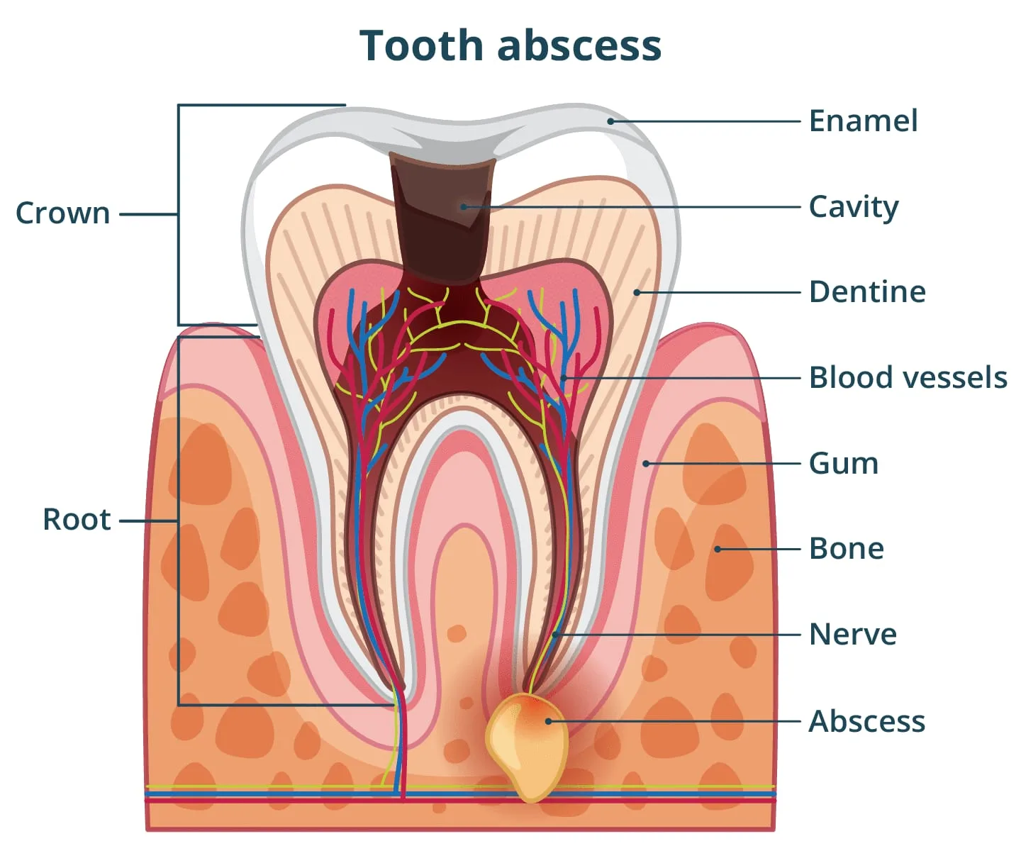 Dental abscess