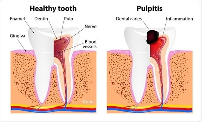 Pulp  inflammation