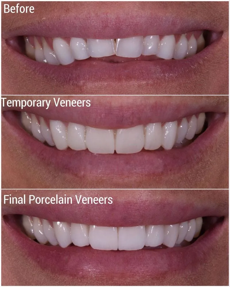 Porcelain veneer - Treatment results