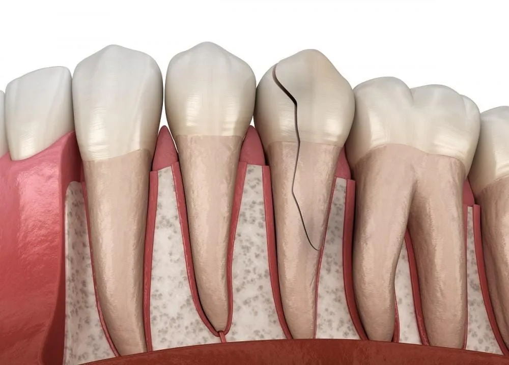 Cracked tooth
