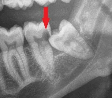 Wisdom tooth damaging adjacent teeth