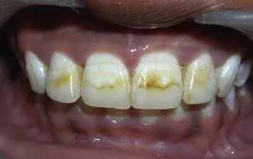Teeth staining due to dental flourosis
