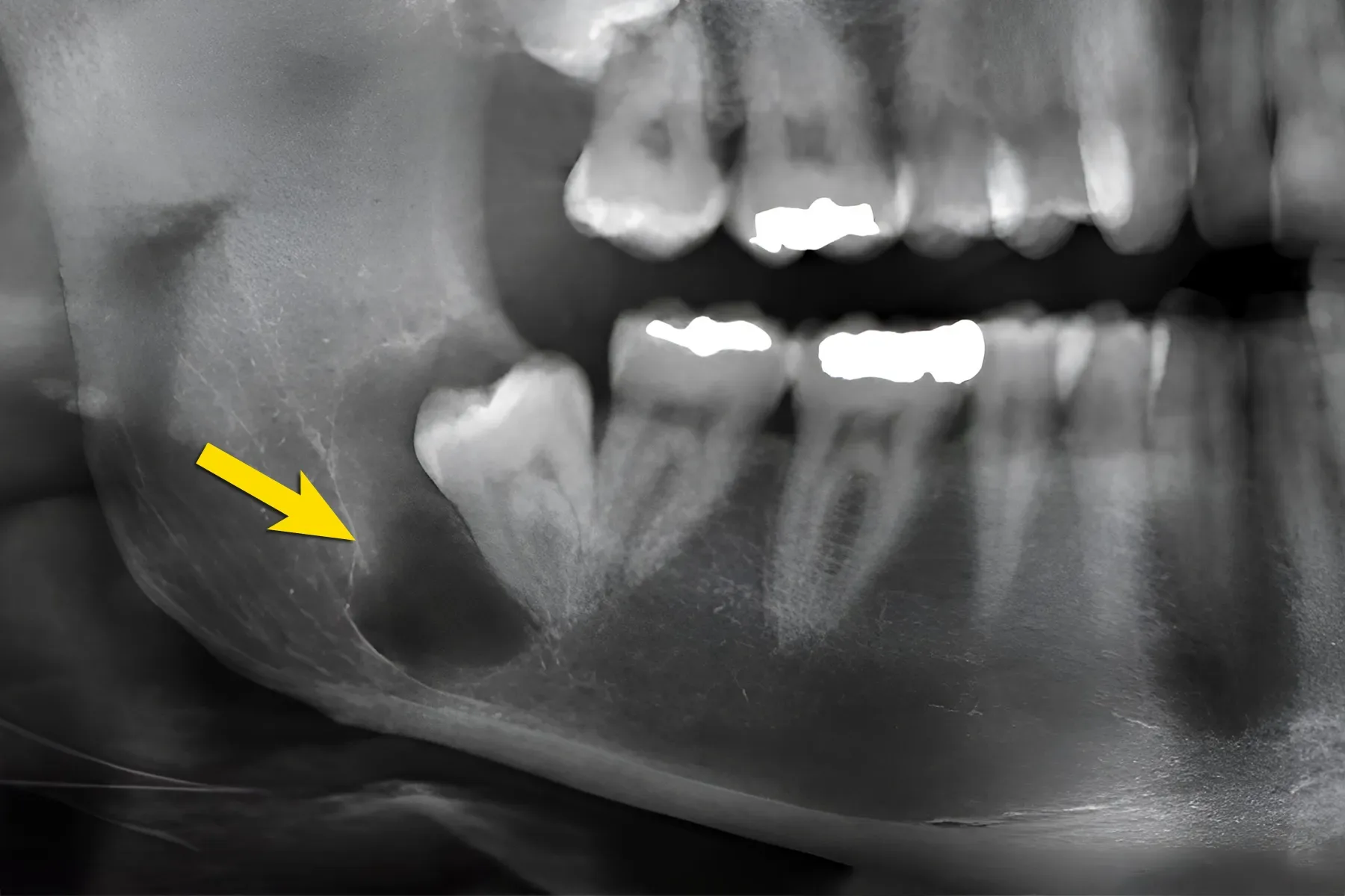 X-ray shows presence of cyst around wisdom tooth