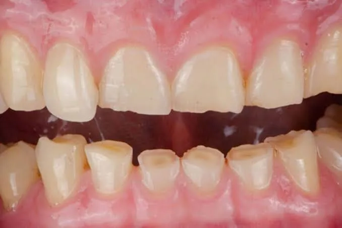 Enamel wear