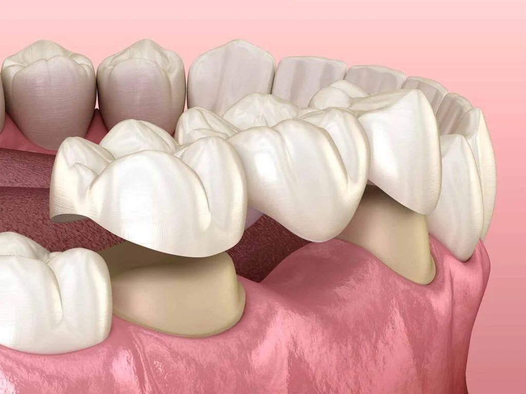Dental Bridge